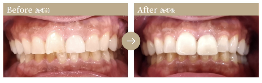 前歯の欠けを整えた2歯の症例