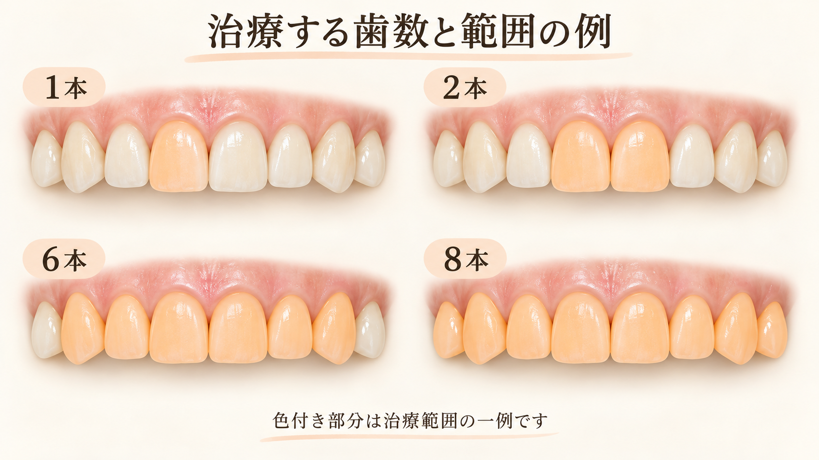 前歯1本・2本・6本・8本について、治療する範囲の例を色分けした説明図